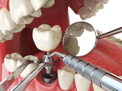 Сколько стоит установить имплант зуба под ключ в Мурманске?