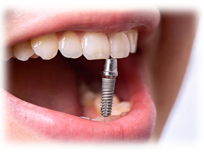 Закрытый синус-лифтинг перед имплантацией зубов