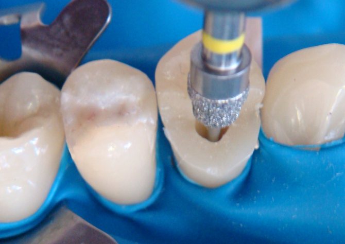 Восстановление зуба на штифте: показания, особенности, цена в Мурманске