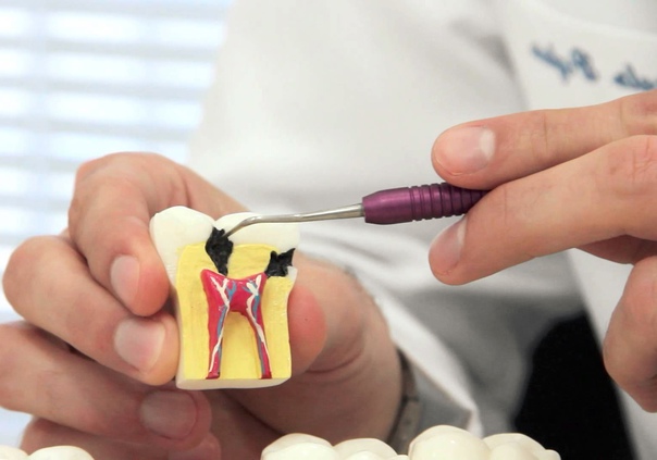 Лечение пульпита в стоматологии Newton в Мурманске