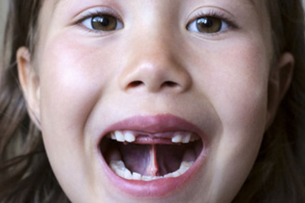 Пластика уздечки губы и языка у детей
